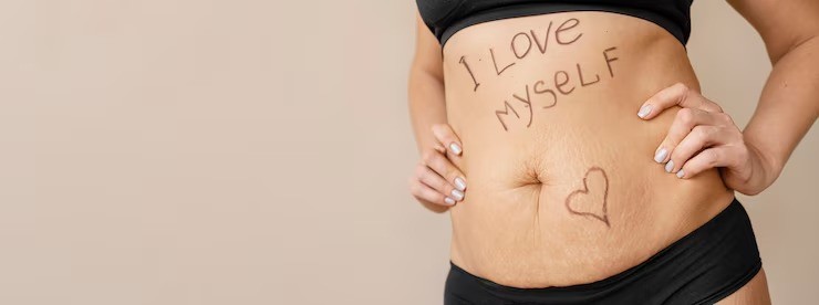 stretch marks saat hamil, cara menghilangkan stretch marks, stretch marks trimester ketiga, krim stretch mark aman untuk ibu hamil, perawatan kulit ibu hamil, tips mencegah stretch marks alami